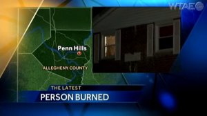 Boy burned in Penn Hills