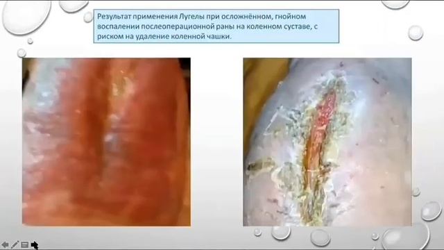 Отзыв - 15 о применении лечебной воды Лугела смотреть онлайн