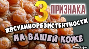 Три признака инсулинорезистентности на коже. Зима с Машей ❄️ Видео №49