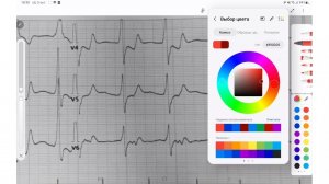 М 88 лет. Феномен ВПВ?
