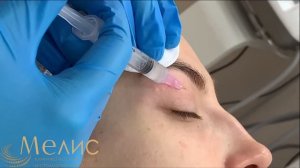 Коллагенотерапия глаз препаратом Collost Micro