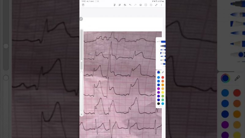 #экг #omi #экстрасистолы #stemi
