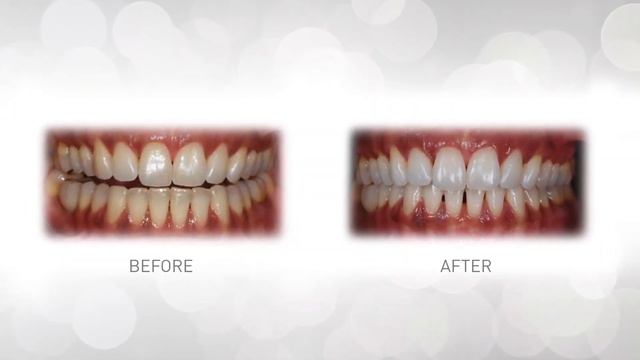 WhiteWash Teeth Whitening Gel