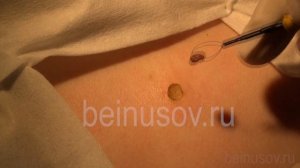 Удаление "родинки" аппаратом ФОТЕК Е81М