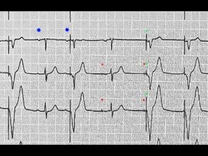 23.02.2021 разбор ЭКГ с ЭКС (работа технического алгоритма)