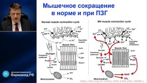 Злокачественная гипертермия Лебединский К.М.