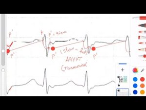 Механизм реентри в АВ узле. АВУРТ