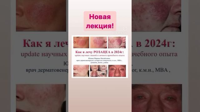 Для пациентов с РОЗАЦЕА