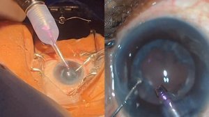 NvN- Phaco with RayOne EMV IOL