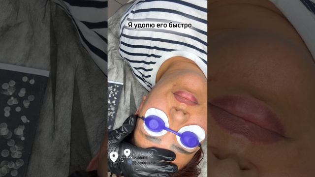 Лазерное удаление бровей