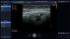 Как выглядит ДИВЕРТИКУЛИТ на УЗИ?