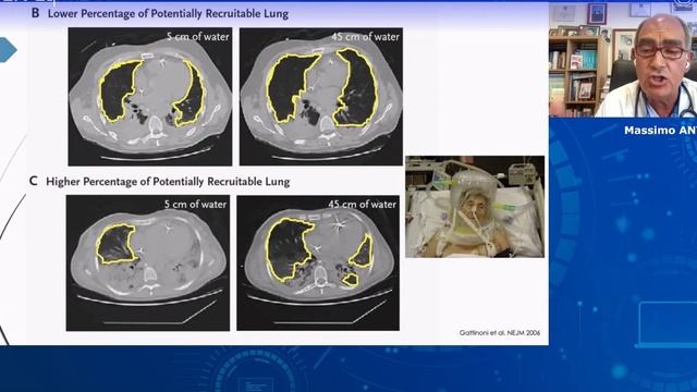 SAFETY OF OXYGENATION VENTILATION IN THE CRITICALLY ILL  webinars ESICM  22