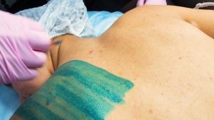 Фракционный мезопилинг спины (синий пилинг) при акне и постакне методом Ablase