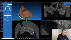 Обучение хирургическим шаблонам в программе RealGuide. Создание шаблона при полной адентии, All-on-6