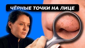 Все о черных точках: причины, методы удаления и советы косметолога по уходу за лицом