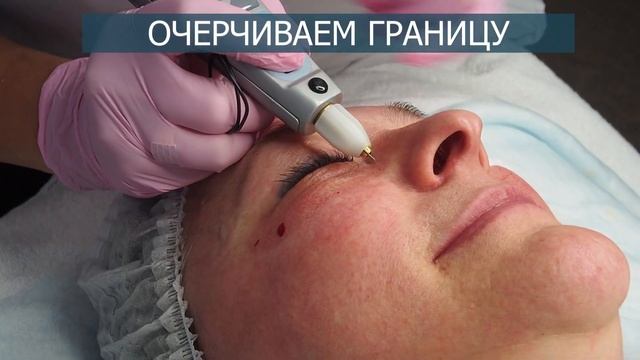 Блефаропластика нижнего века