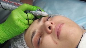 Безоперационная блефаропластика верхнего века