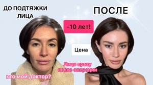Подтяжка лица в 31 год. ЗАЧЕМ?  Восстановление после операции. Сколько стоит?