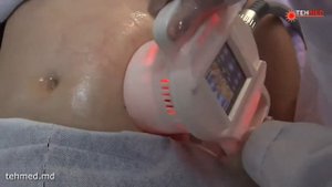 Аппарат высокосфокусированного ультразвука HIFU+RF V5 PRO