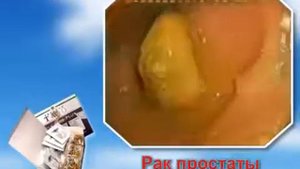 Кишечник до и после программы Коло-Вада Плюс