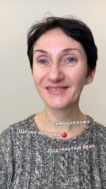 Сегодня хотим поделиться комплексной работой полимолочной кислотой GANA PHV и филлерами PHILOS