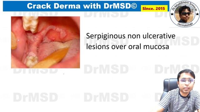 Secondary Syphilis | Snail Track Ulcers | Condyloma lata | Nummular | Moth-Eaten Alopecia | Dermgya