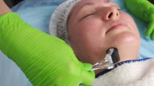 Гайд по процедуре с пилингом мансол (Manssol)