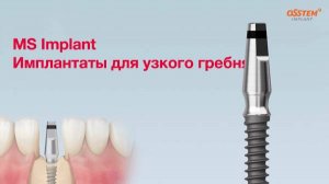 MS Имплантат. Имплантаты для узкого гребня