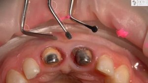 Как выполнить ретракцию десны | How to Dentist
