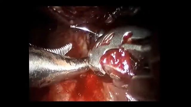 TORS Tonguebase Resection and Pharyngopallatoplasty смотреть онлайн
