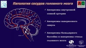Паралитическое косоглазие у пациентов при нейрохирургической патологии. Причины, следствия, тактика.