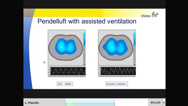 Why should we let our patients breathe (even in ECMO)-2018 Leo Heunks
