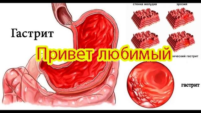 Гастрит