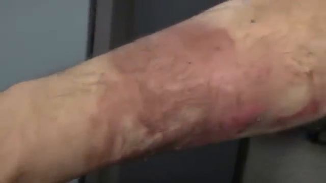 Porsche burned my arm 2006 911s airbag burned my arm смотреть онлайн