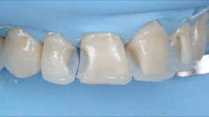 Реставрация передних зубов. Front teeth restoration. Capo Natural (Schutz).
