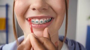 Межзубные ершики для обладателей брекетов