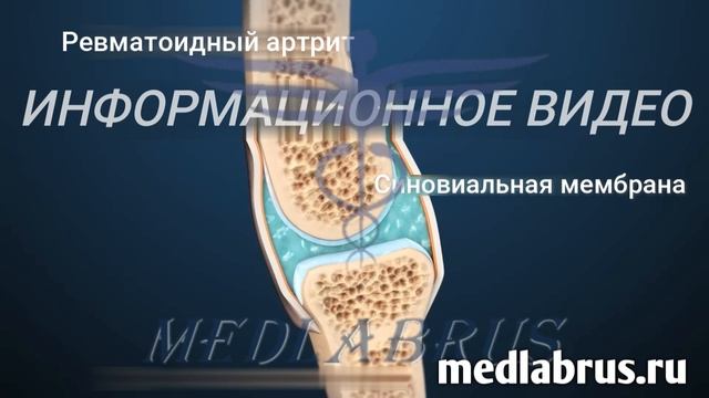 Артрит ревматоидный