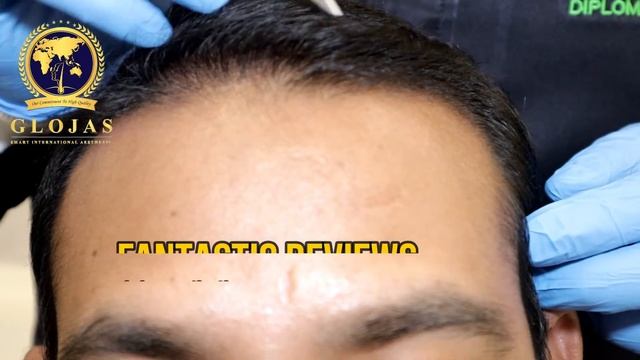 SMART™ FUE Hair Transplant ( 3 Months Review ) @ Hair Transplant Malaysia Specialist смотреть онлайн