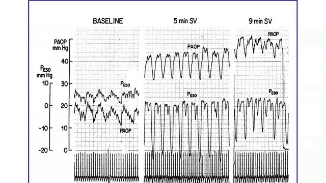 Assessing resp mechanics and patient's effort in assisted mech venti A Pesenti