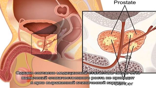 Факторы, провоцирующие развитие злокачественного рака предстательной железы смотреть онлайн