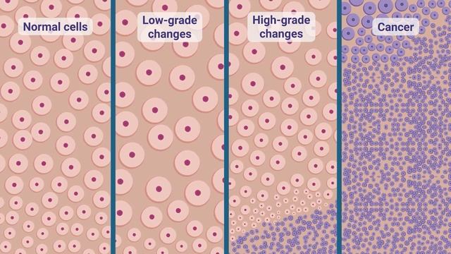 ACOG Explains: Cervical Cancer Screening смотреть онлайн
