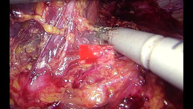 Metástasis suprarrenal tras carcinoma renal. Extirpación laparoscópica. Suprarenal metástasis. смотреть онлайн
