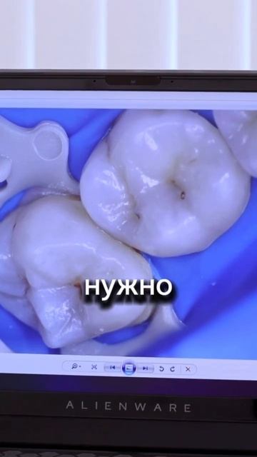 Черные точки на зубах. Лечить или оставить?