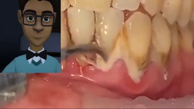 teeth tartar cleaning.most important harms of dental calculus? смотреть онлайн