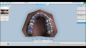 Работают ли элайнеры для выравнивания зубов?