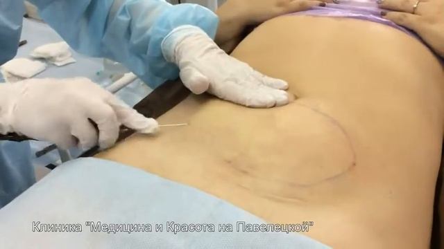 Лазерный липолиз (липосакция) в клинике 