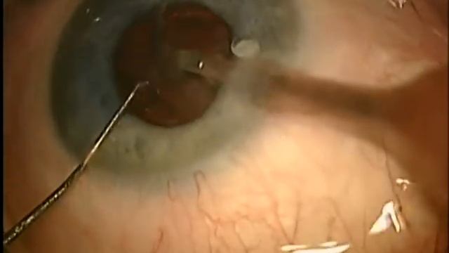 Факоэмульсификация с имплантацией ИОЛ смотреть онлайн