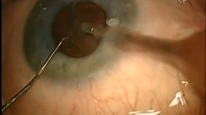 Факоэмульсификация с имплантацией ИОЛ