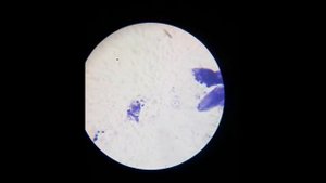 Грибок в ушах, отомикоз