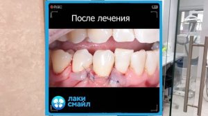 Рецессия десны, что это и как ее лечить.